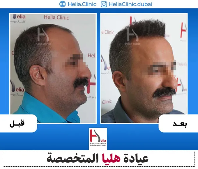 نتيجة زراعة الشعر بتقنية DHI