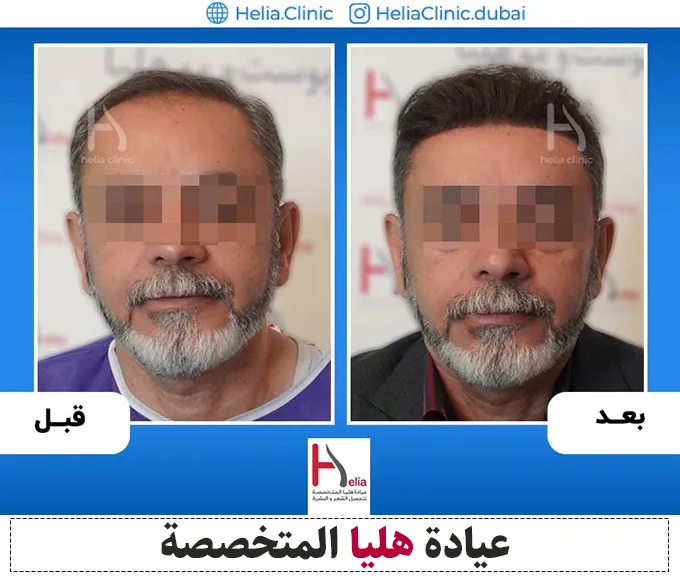 نتيجة زراعة الشعر بطريقة میکروجرافت