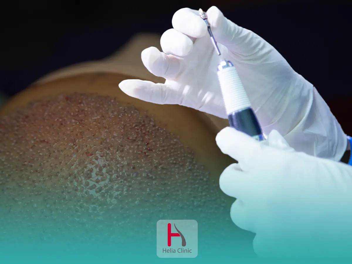 زراعة الشعر بالاقتطاف FUE