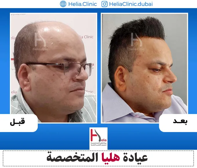 صور قبل وبعد لزراعة الشعر بتقنية Micro Fue
