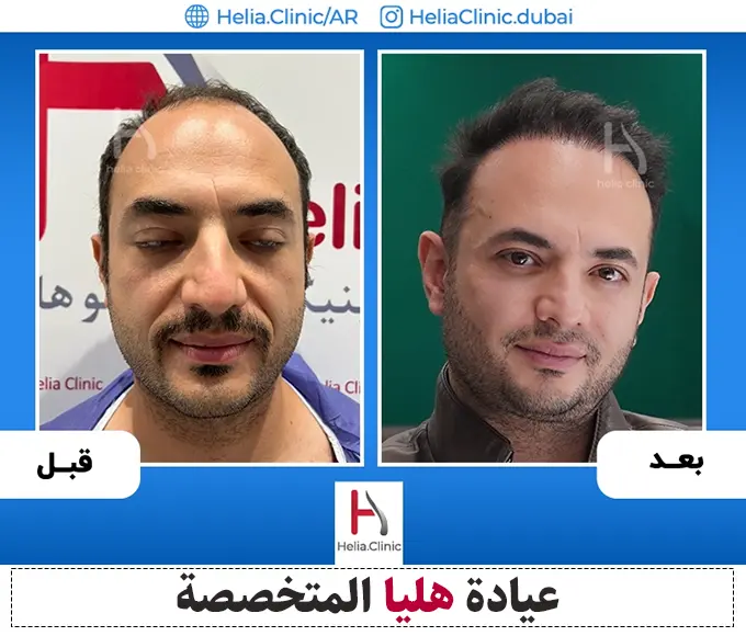قبل وبعد زراعة الشعر بتقنية Fue في عيادة هليا