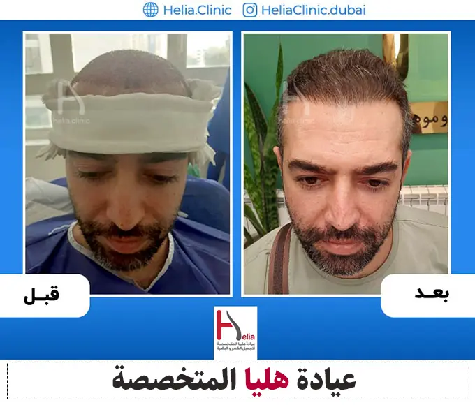 صور لزراعة الشعر بطريقة SUPER FUE