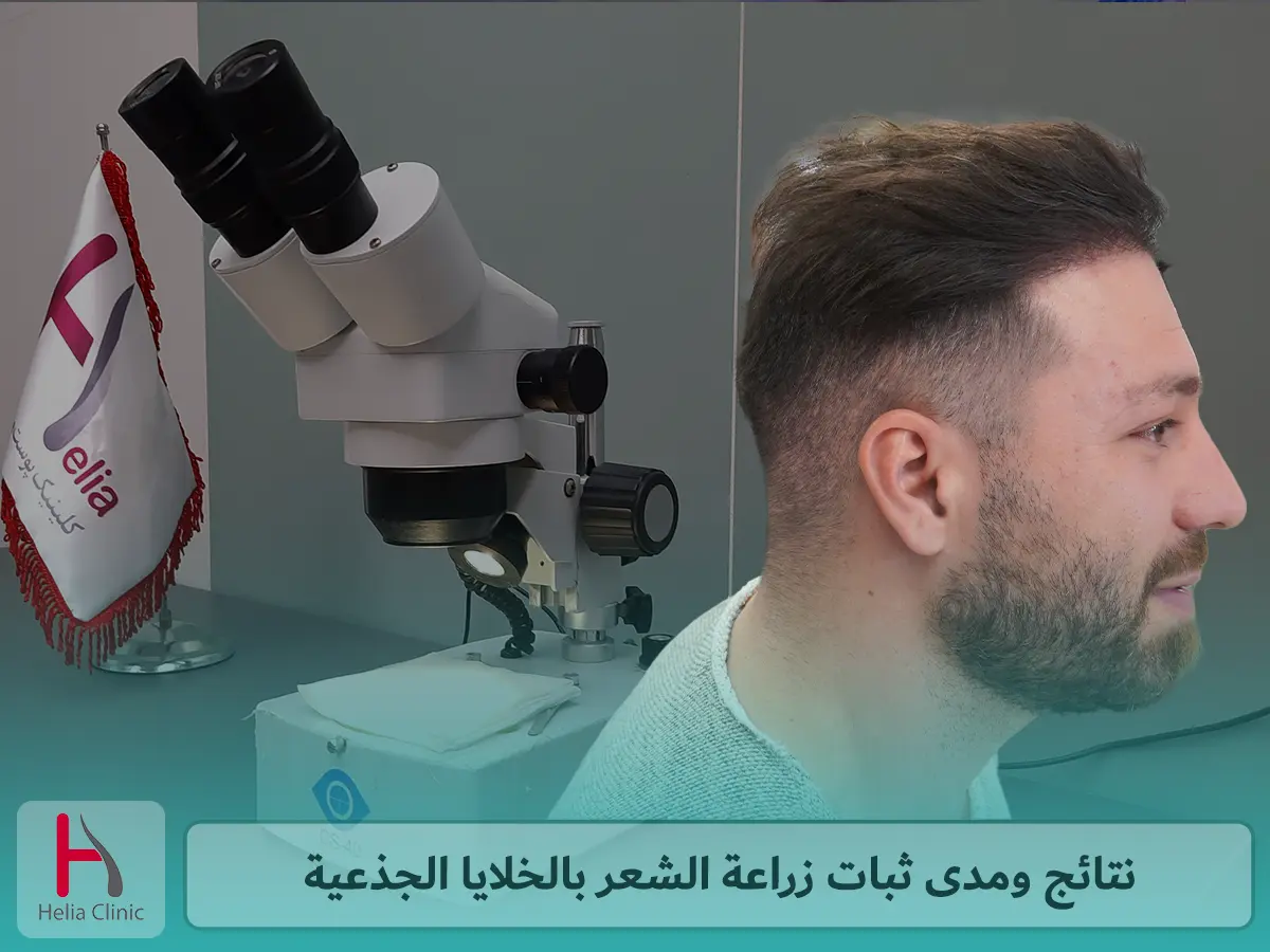 نتائج ومدى ثبات زراعة الشعر بالخلايا الجذعية