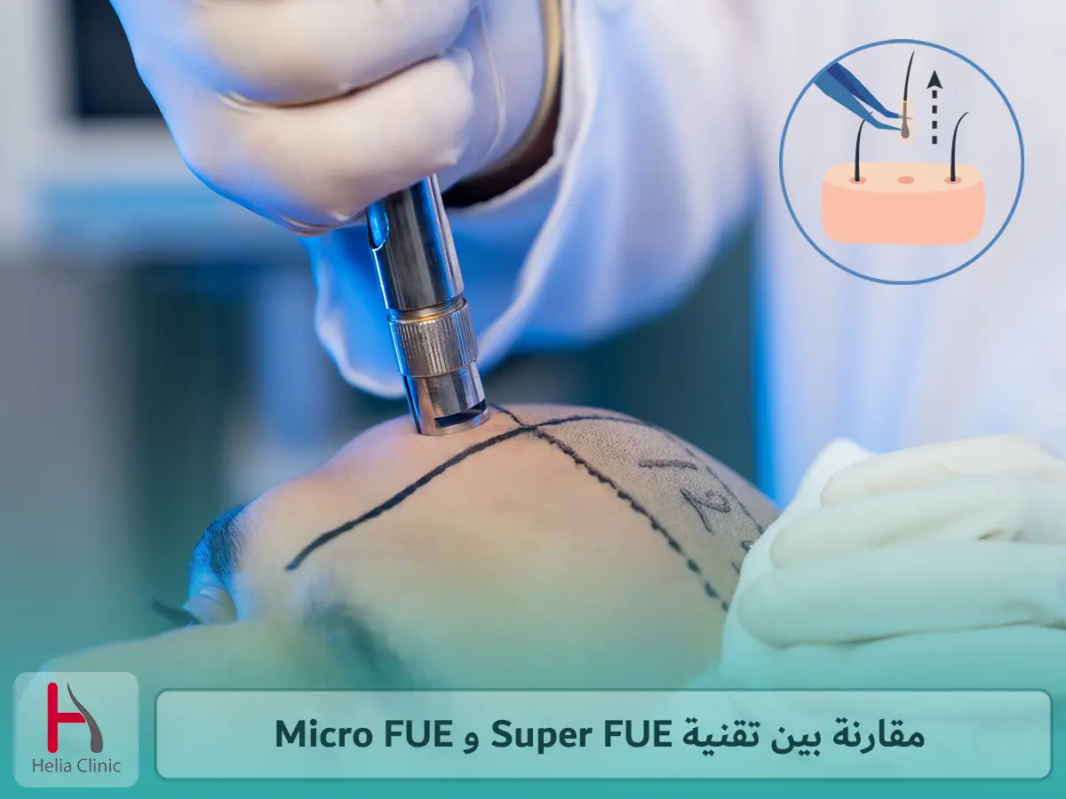 مقارنة بين زراعة الشعر Super FUE و Micro FUE