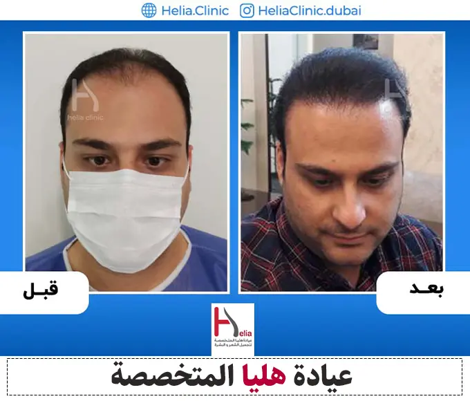 نتيجة زراعة شعر الطبيعي بتقنية FUE