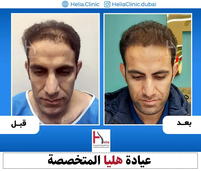 صور قبل وبعد لزراعة الشعر في منطقة التاج