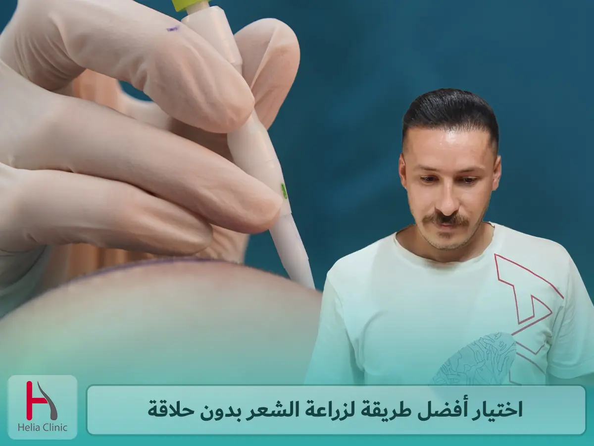 اختيار أفضل طريقة لزراعة الشعر بدون حلاقة