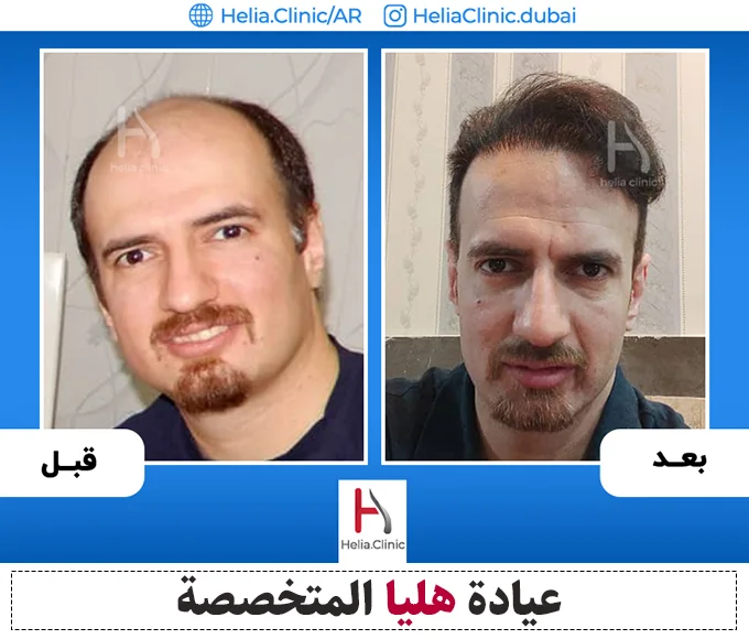 تفاصيل زراعة الشعر بدون حلاقة