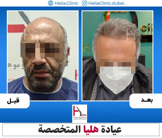 نتيجة نمو الشعر المزروع في منطقة قمة الرأس