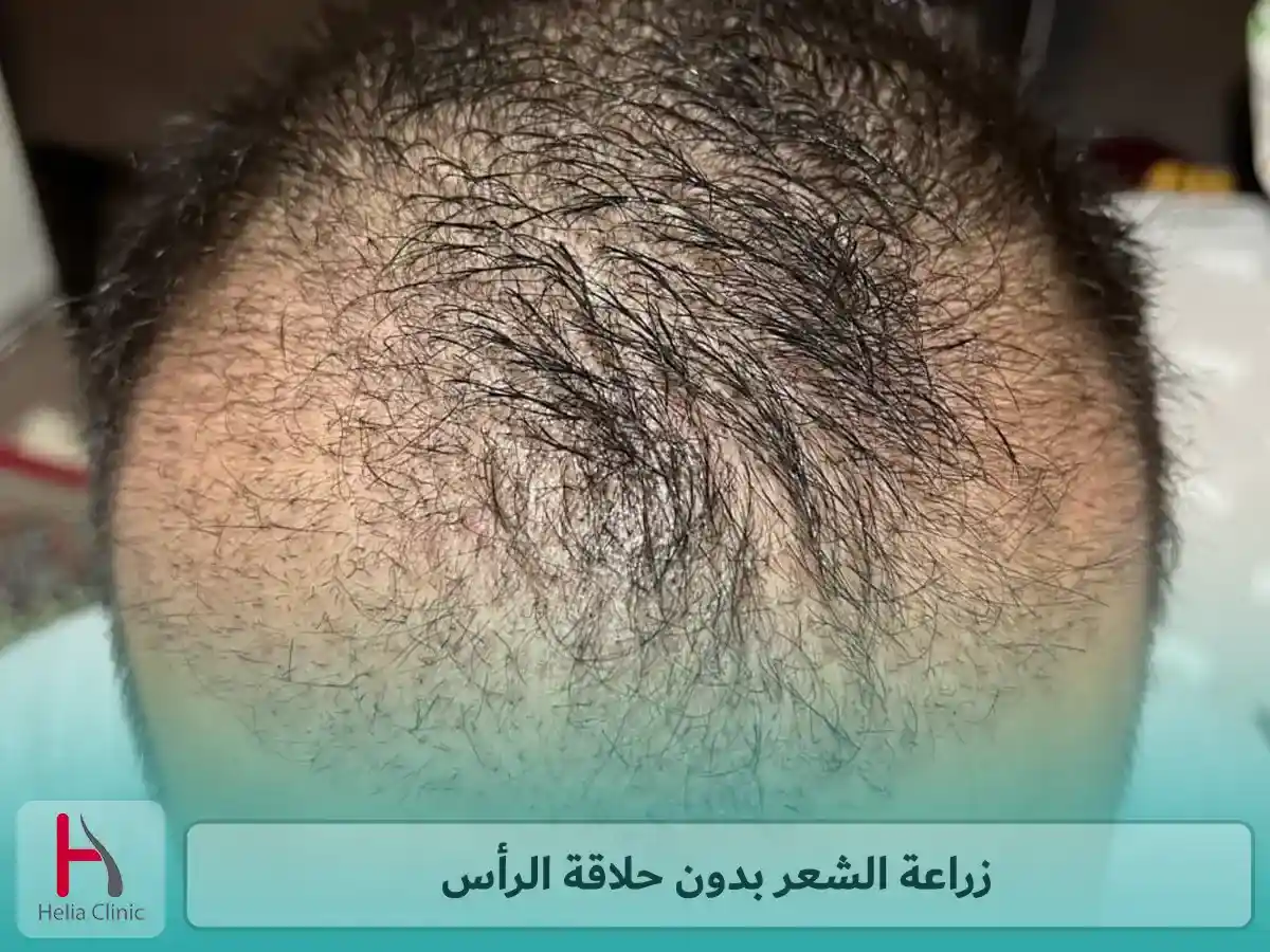 زراعة الشعر بدون حلاقة الرأس في عيادة هليا