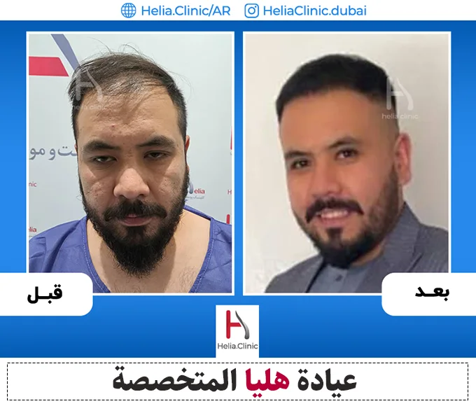 زراعة الشعر بدون حلاقة في دبي
