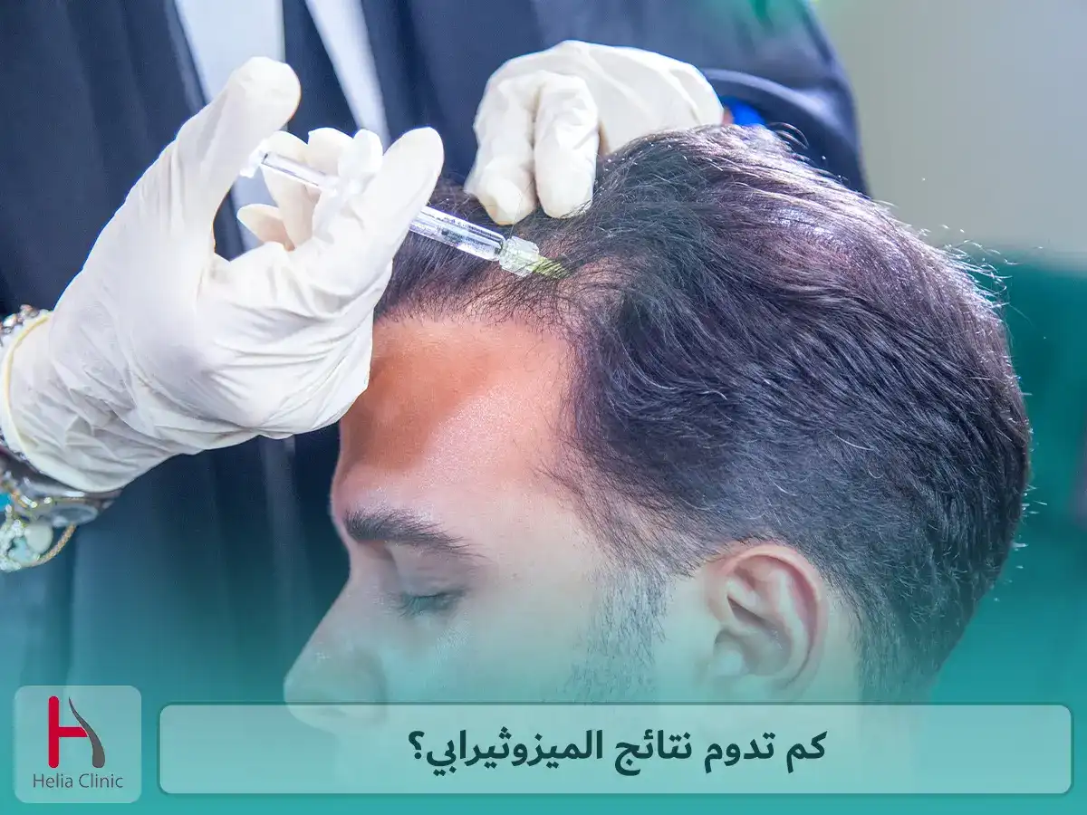 كم تدوم نتائج الميزوثيرابي؟