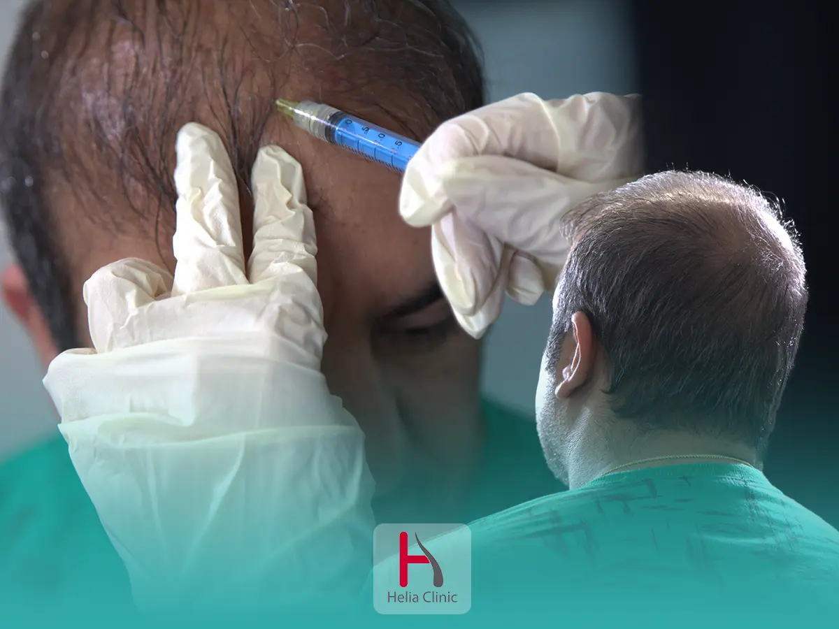 ميزوثيرابي الشعر