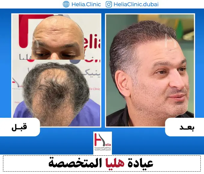 صور زراعة الشعر في منتصف الرأس