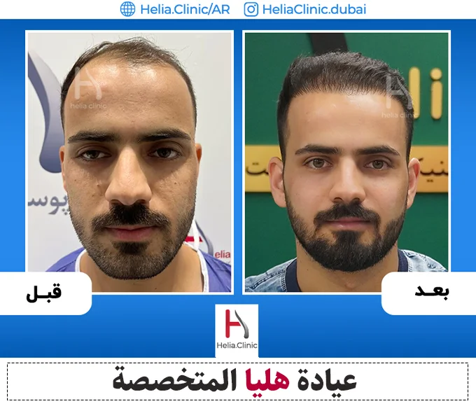 صورة لزراعة الشعر بدون قص وحلق الرأس