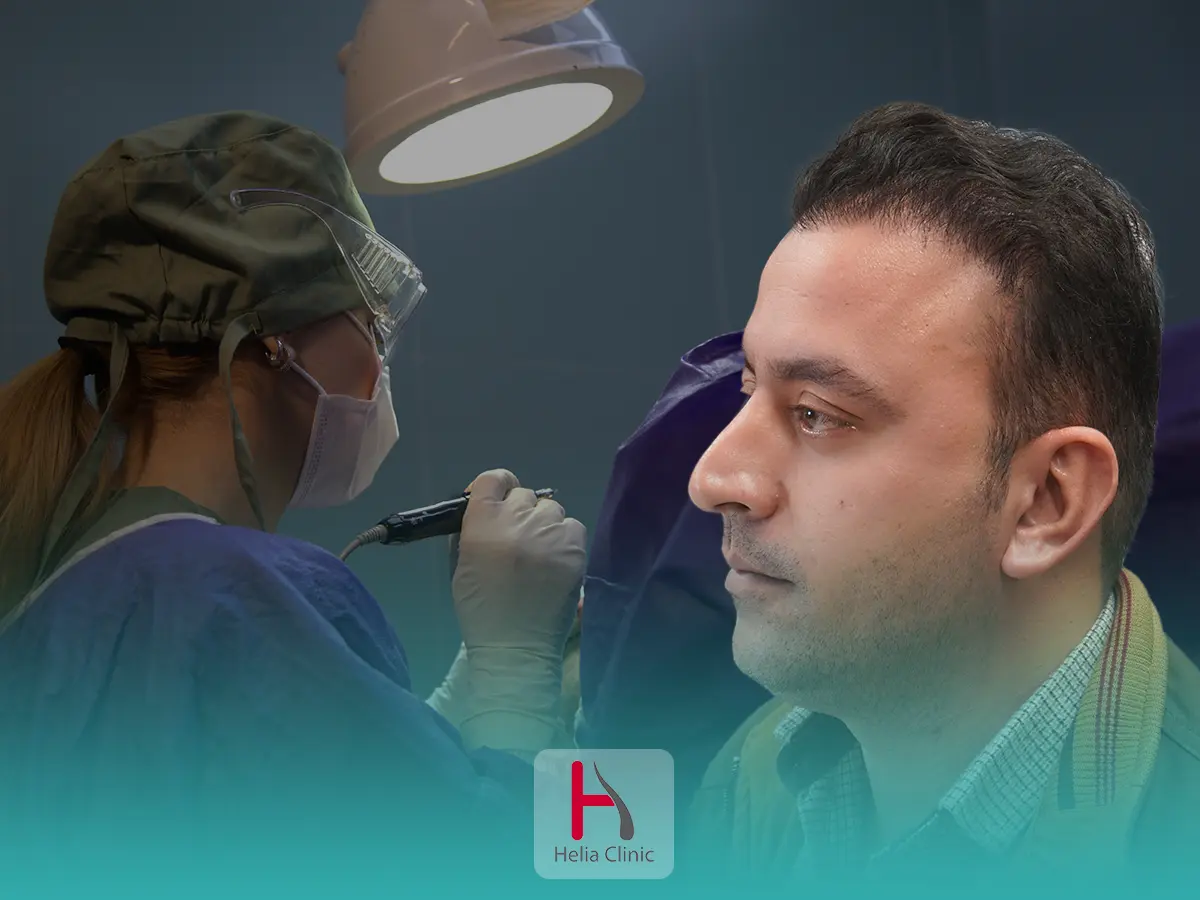 زراعة الشعر دون حلاقة