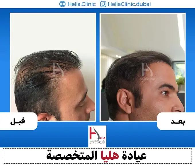 نتائج زراعة الشعر في منطقة التاج