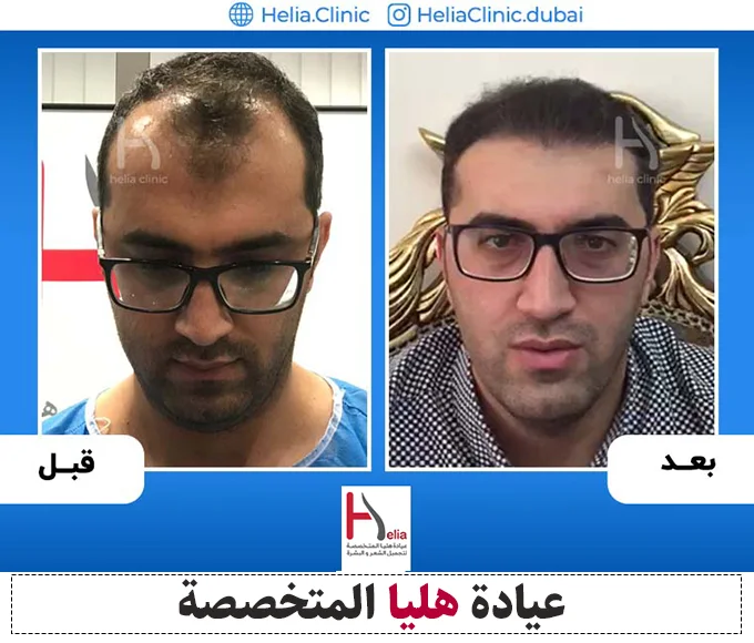 نتيجة زراعة الشعر بدون حلاقة الرأس