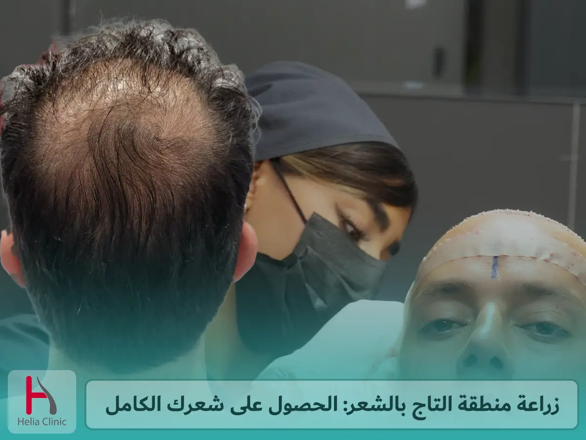 نتائج زراعة منطقة التاج في أفضل عيادة في دبي
