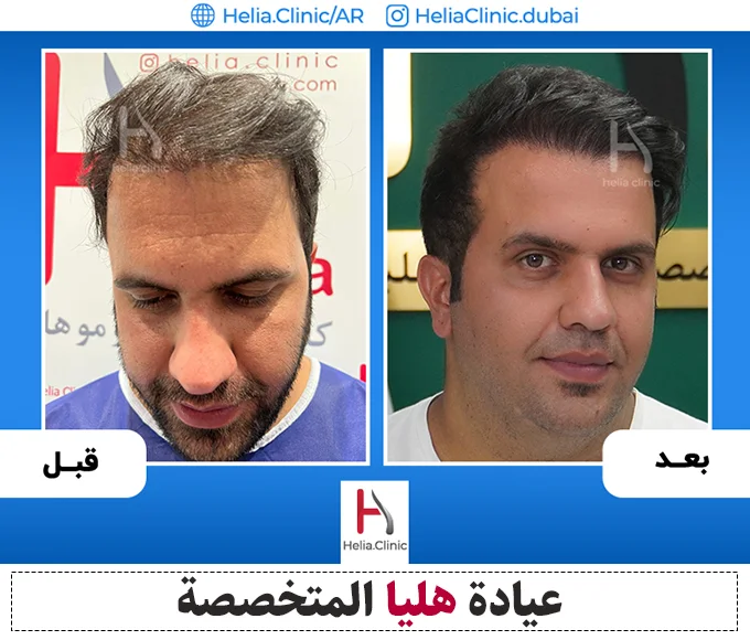صور قبل وبعد عملية زراعة الشعر بتقنية fut