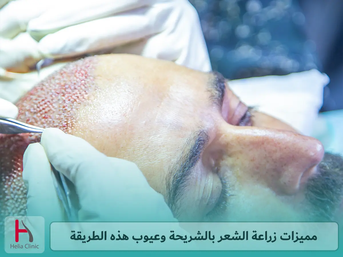 مميزات زراعة الشعر بالشريحة وعيوب هذه الطريقة