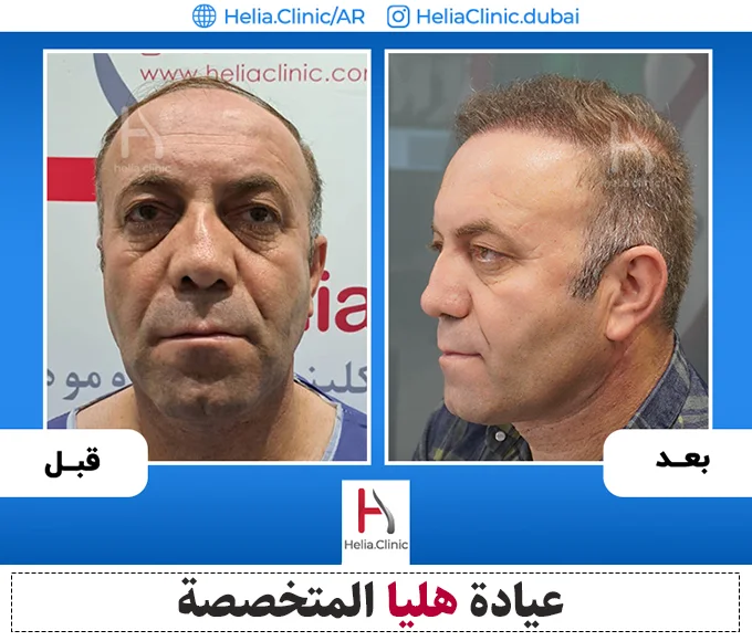 زراعة الشعر بطريقة الشريحة في عيادة هليا