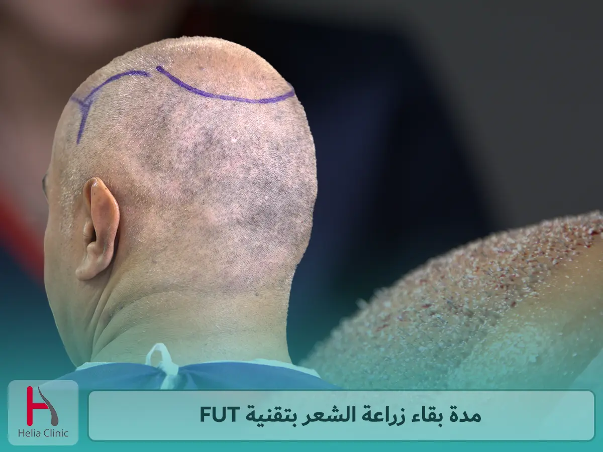 مدة بقاء زراعة الشعر بتقنية FUT
