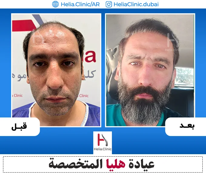 صور زراعة الشعر بطريقة الشريحة