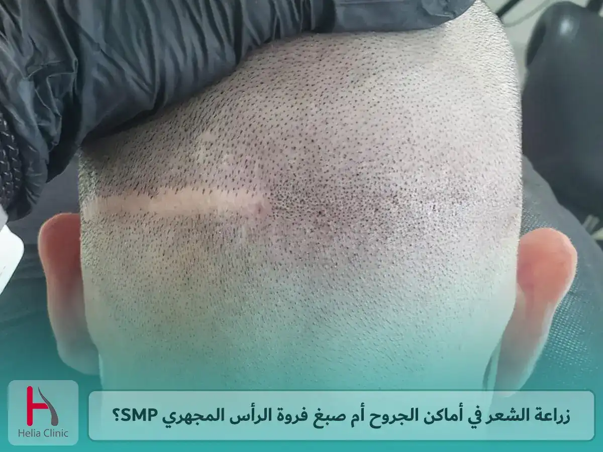 زراعة الشعر في أماكن الجروح أم صبغ فروة الرأس المجهري SMP؟