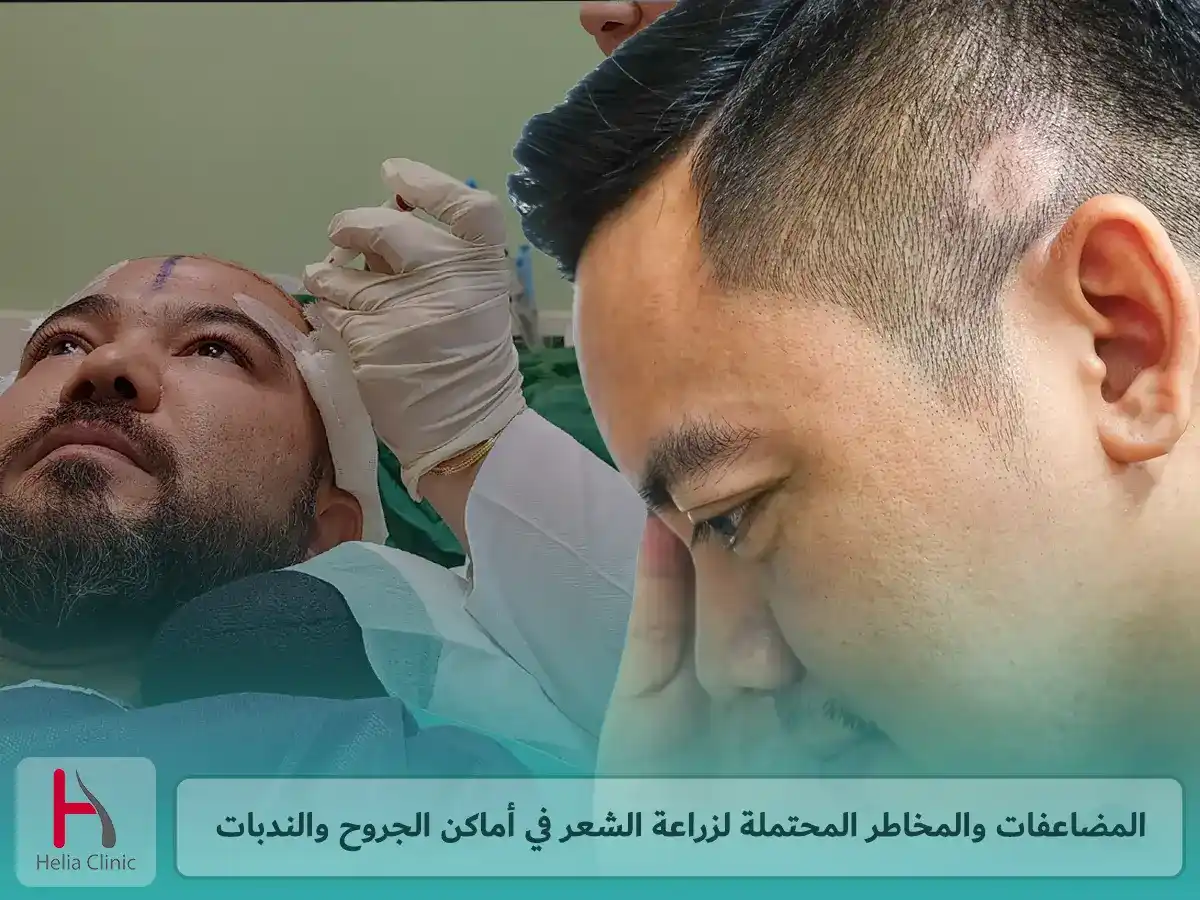 المضاعفات والمخاطر المحتملة لزراعة الشعر في أماكن الجروح والندبات