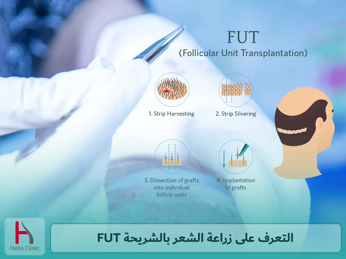 التعرف على تقنية زراعة الشعر بالشريحة FUT