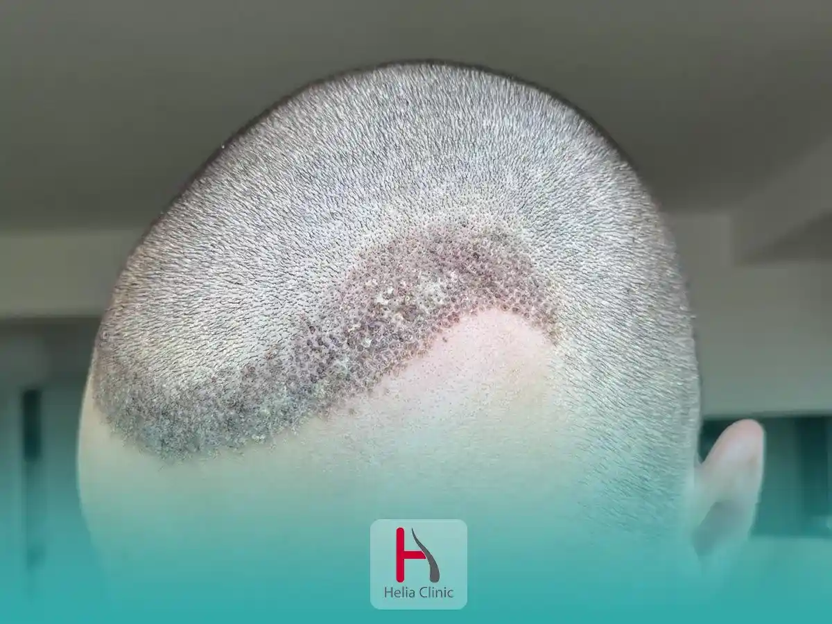 قشرة الرأس بعد عملية زراعة الشعر