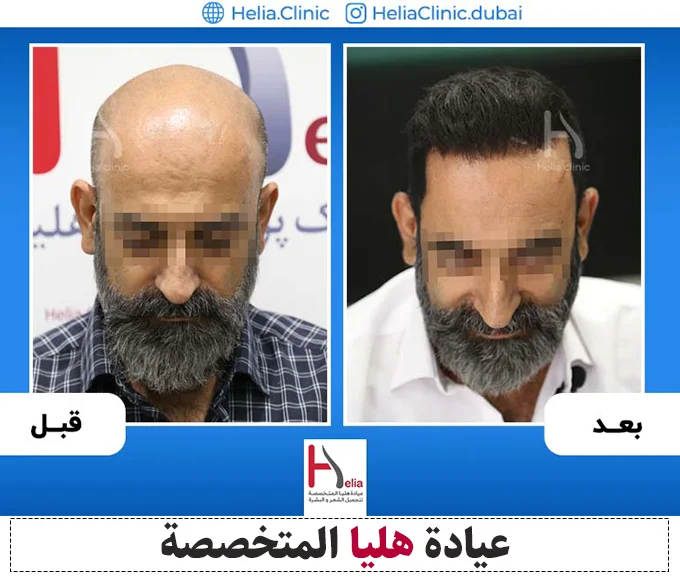نتيجة زراعة الشعر بتقنية FUT