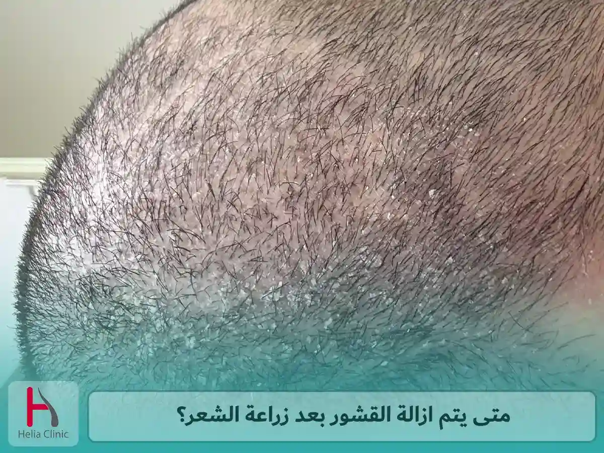 متى يتم ازالة القشور بعد زراعة الشعر؟