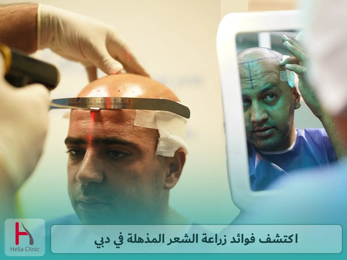 اكتشف فوائد زراعة الشعر المذهلة في دبي