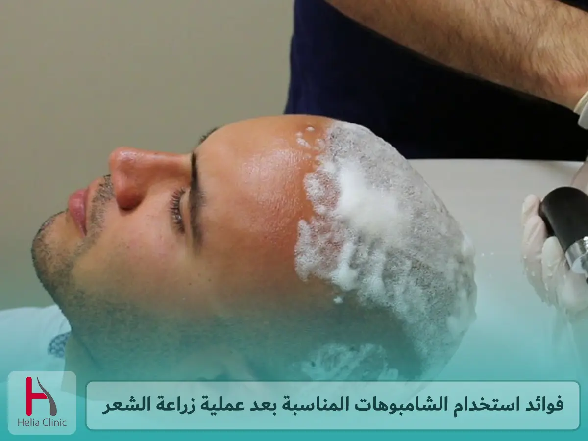 فوائد استخدام الشامبوهات المناسبة بعد عملية زراعة الشعر
