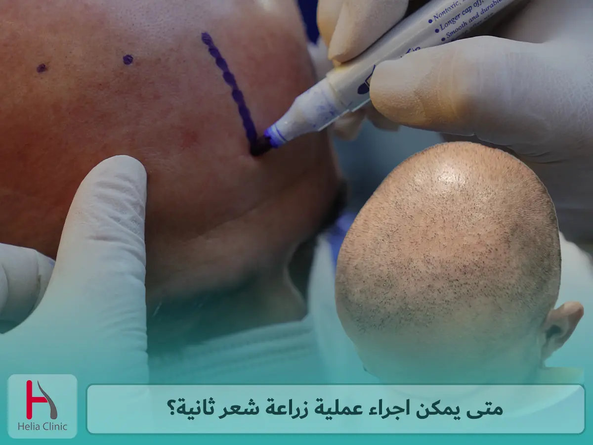 متى يمكن اجراء عملية زراعة شعر ثانية؟