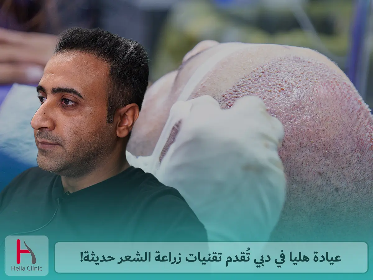 عيادة هليا في دبي تُقدم تقنيات زراعة الشعر حديثة!