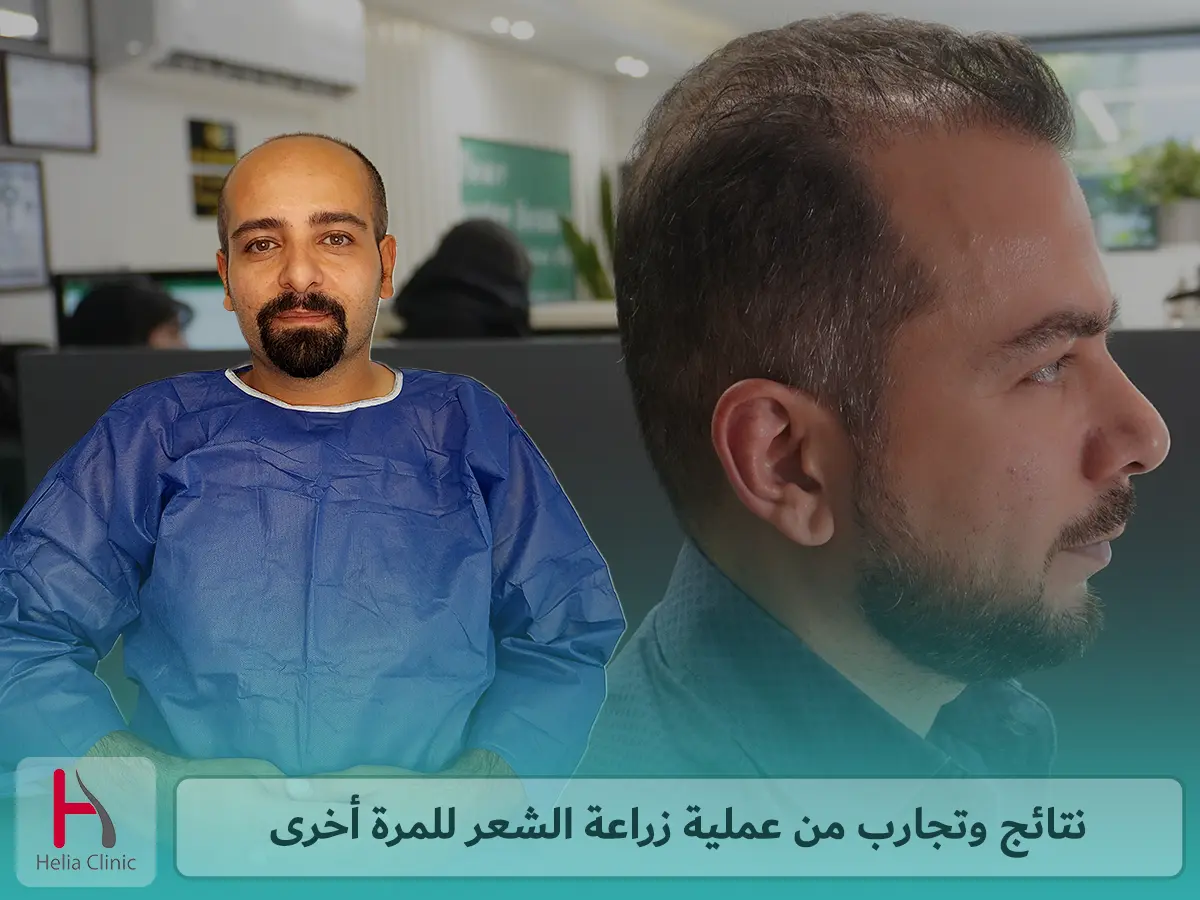 نتائج وتجارب من عملية زراعة الشعر للمرة أخرى