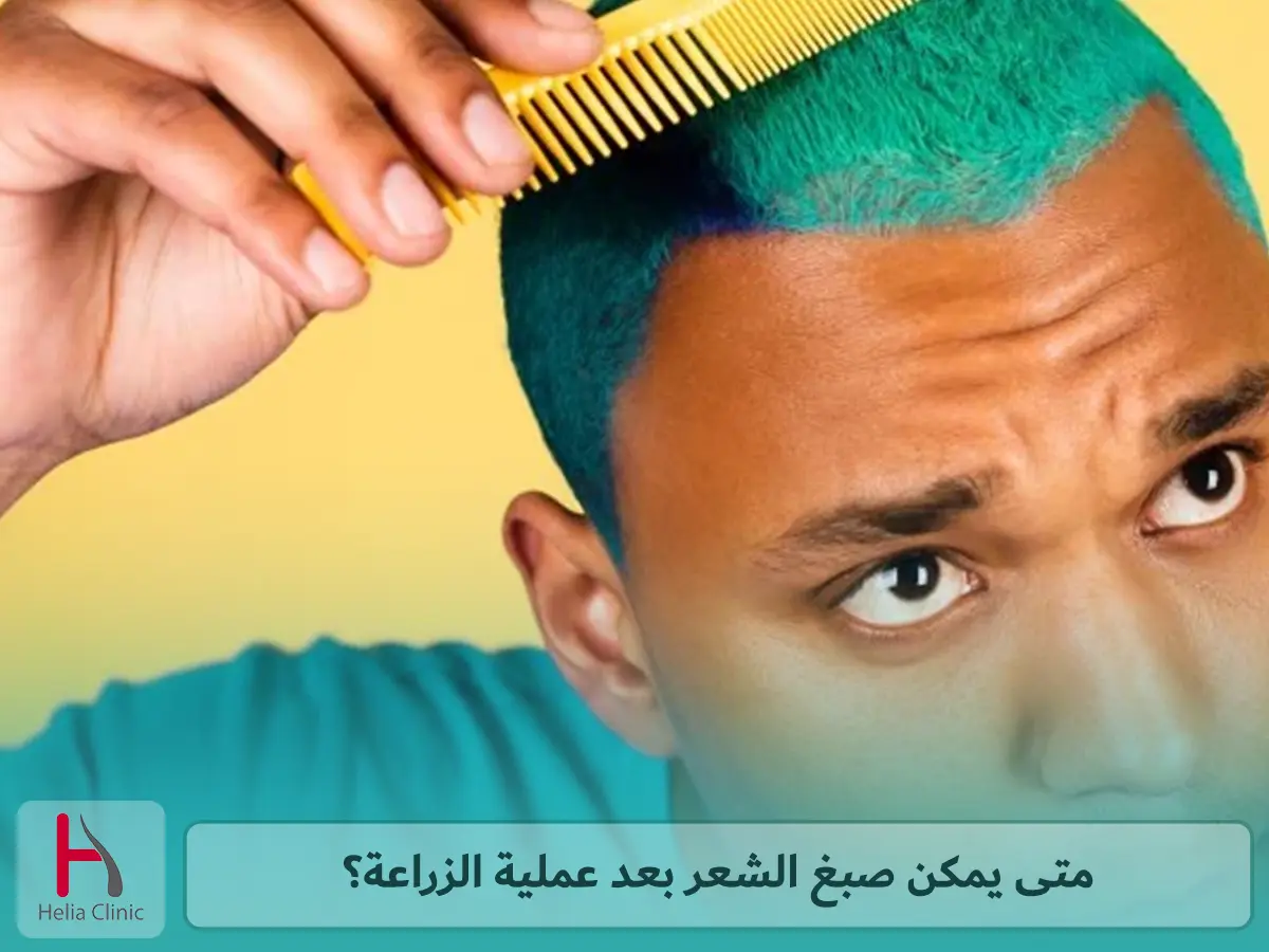 متى يمكن صبغ الشعر بعد عملية الزراعة؟