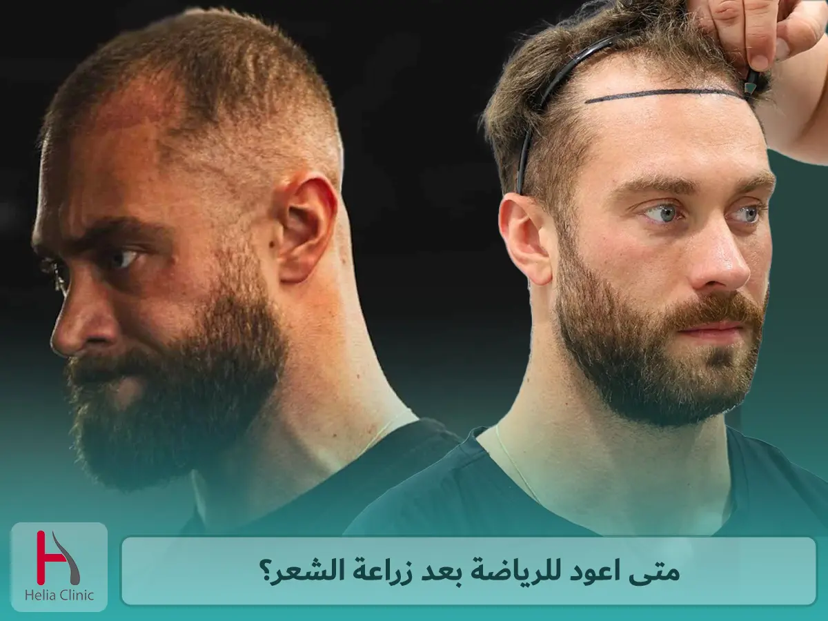 متى اعود للرياضة بعد زراعة الشعر؟