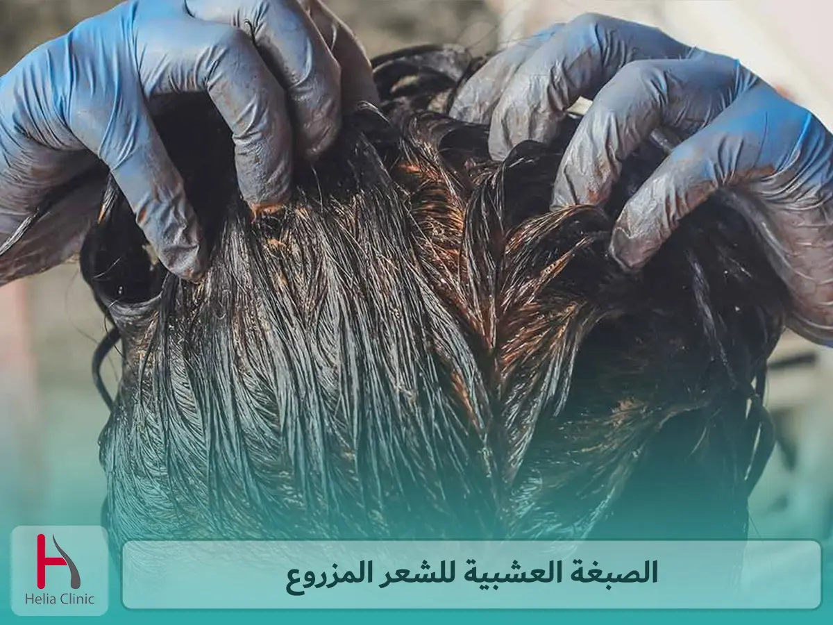 الصبغة العشبية للشعر المزروع