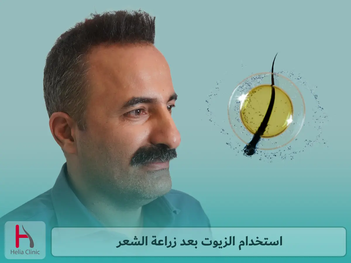 استخدام الزيوت بعد زراعة الشعر