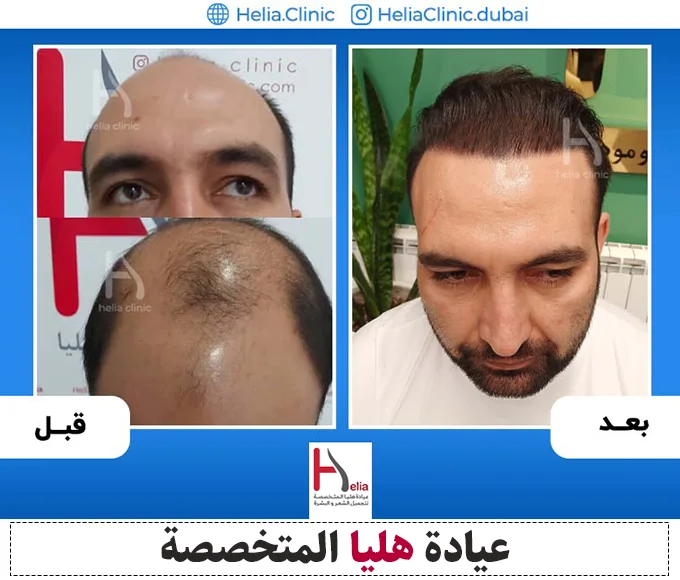 تقييم أفضل عيادة استعادة الشعر في دبي