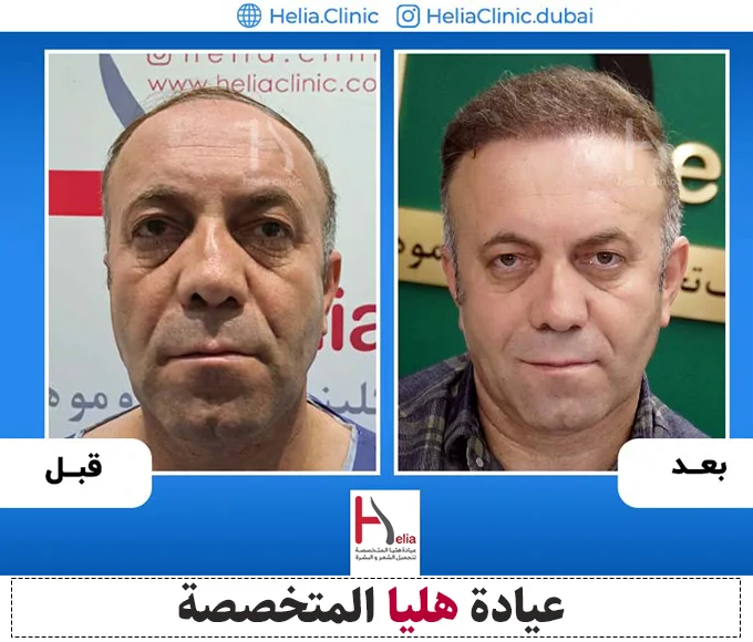 تجربتي في زراعة الشعر في دبي