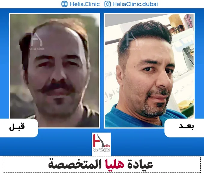 نتيجة أفضل الدكتور ترميم الشعر في الامارات