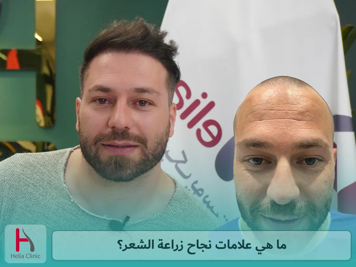 ما هي علامات نجاح زراعة الشعر؟