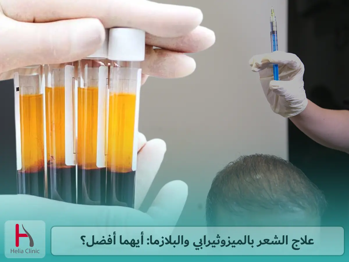 علاج الشعر بالميزوثيرابي والبلازما: أيهما أفضل؟