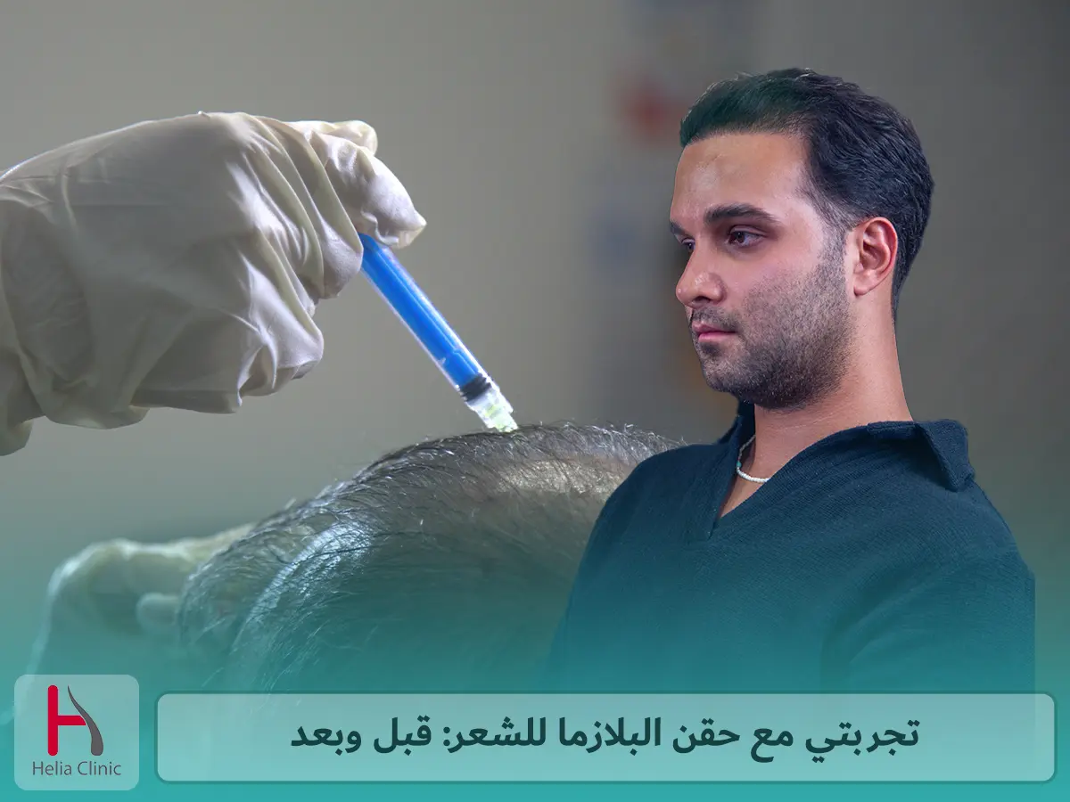 تجربتي مع حقن البلازما للشعر: قبل وبعد