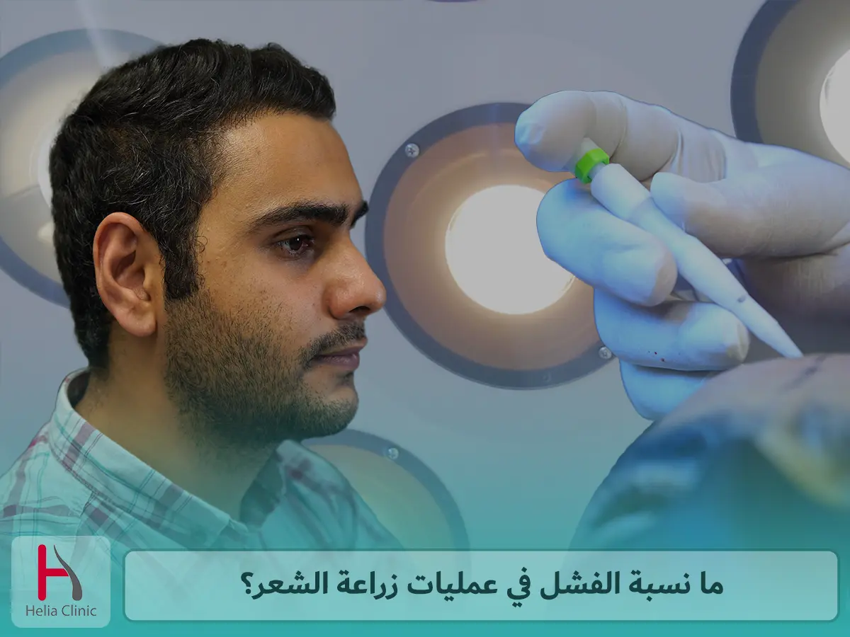 ما نسبة الفشل في عمليات زراعة الشعر؟